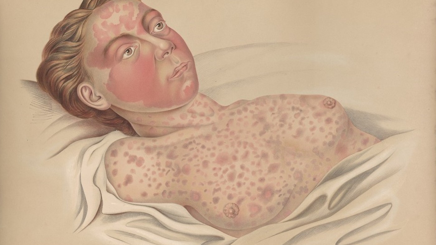 Eine mit Cholera infizierte Person
                                 (Atlas der Hautkrankheiten von Ferdinand von Hebra, 1856) | © Narrenturm 