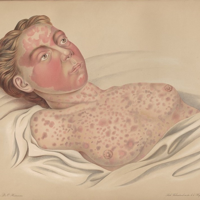 Eine mit Cholera infizierte Person (Atlas der Hautkrankheiten von Ferdinand von Hebra,
                                 1856) | © Narrenturm 