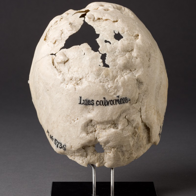 Syphiliserkrankung, Schädel-Kalotte © NHM Wien, Wolfgang Reichmann